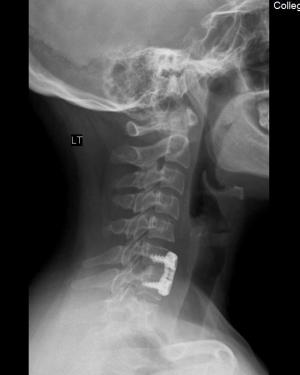 cervical spine fusion with plates 