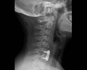 Cervical spine fusion with screws and plate